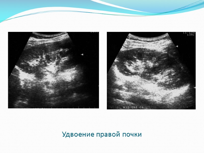 Удвоение правой почки